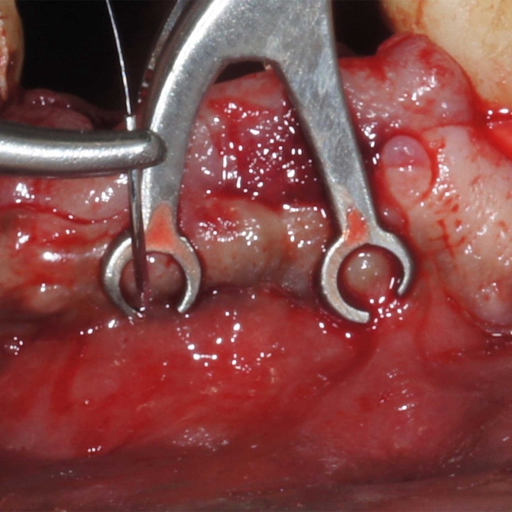2315-60F-Naht-und-Membranpinzette-I-2-x-2-2-mm-abgewinkelt-ergonomische-Dentalinstrumente-Anwendung2