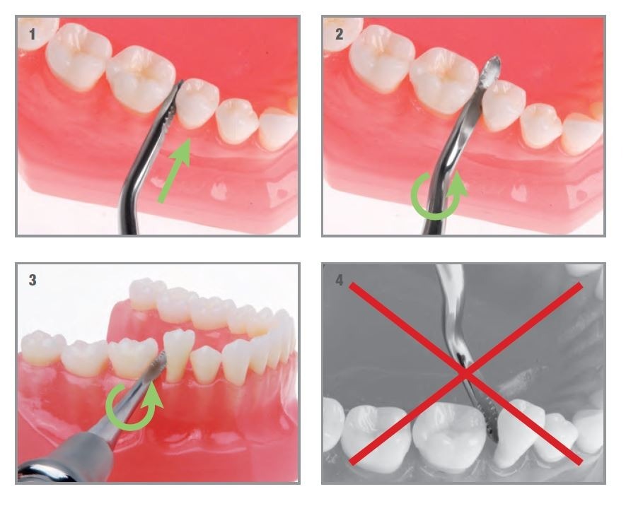 Pivot-Point-Wurzelheber-GESAMT